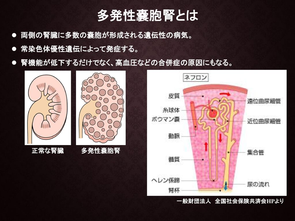多発性嚢胞腎とは 両側の腎臓に多数の嚢胞が形成される遺伝性の病気。 常染色体優性遺伝によって発症する。