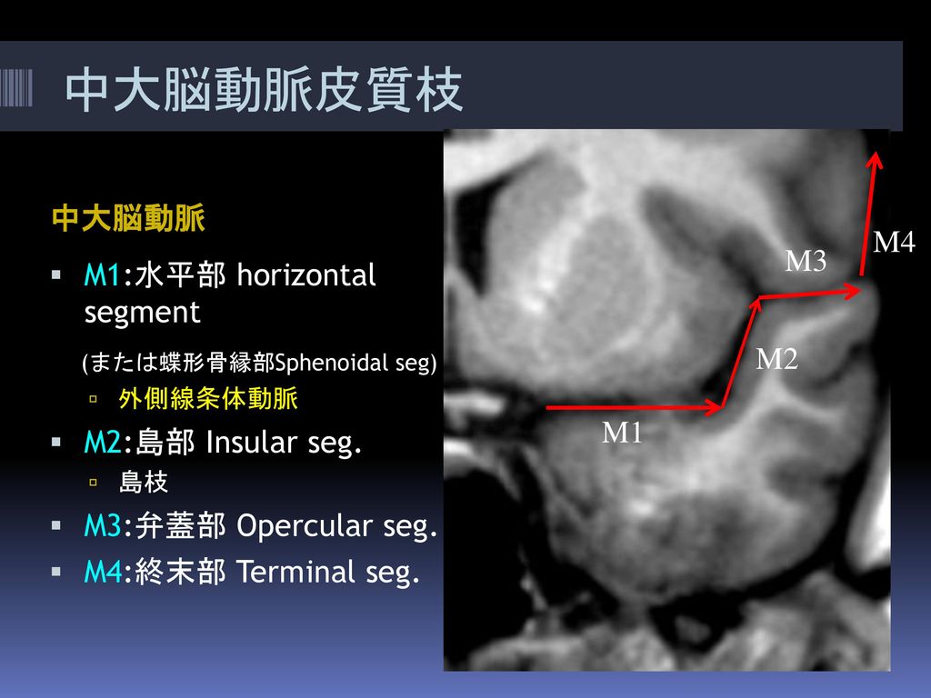 中大脳動脈皮質枝 中大脳動脈 M4 M3 M1:水平部 horizontal segment