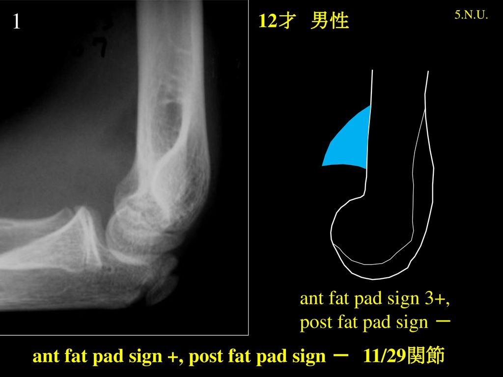 1 12才 男性 ant fat pad sign 3+, post fat pad sign －