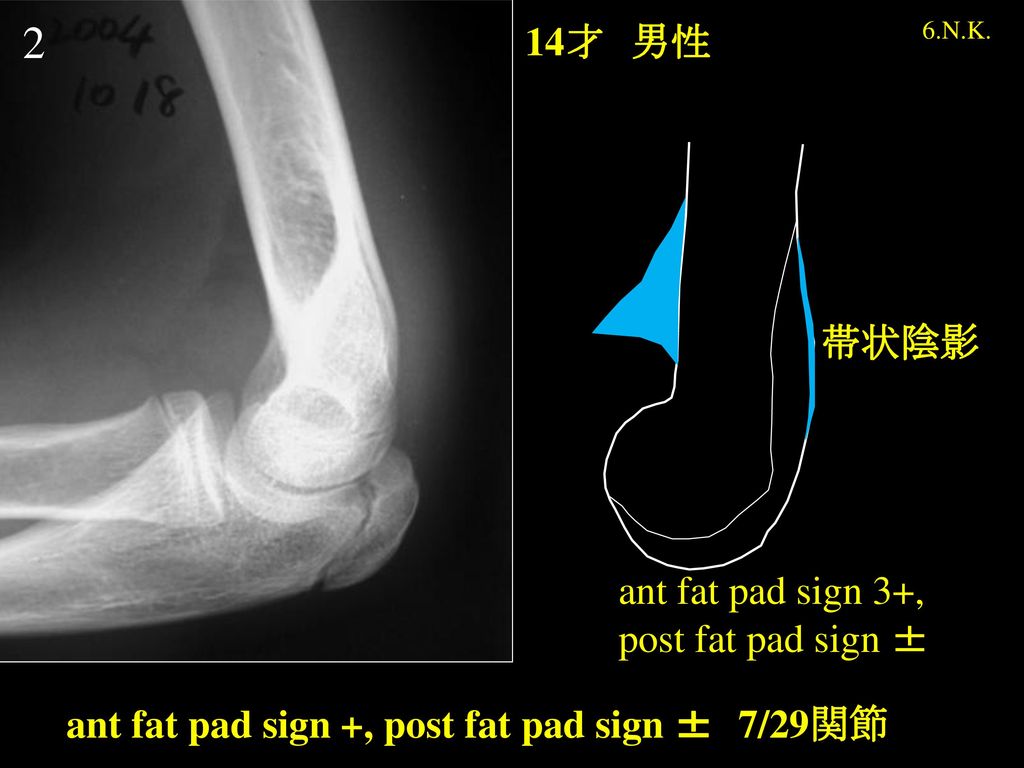 2 14才 男性 帯状陰影 ant fat pad sign 3+, post fat pad sign ±