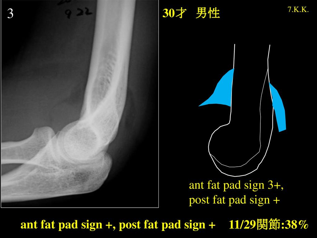 3 30才 男性 ant fat pad sign 3+, post fat pad sign +
