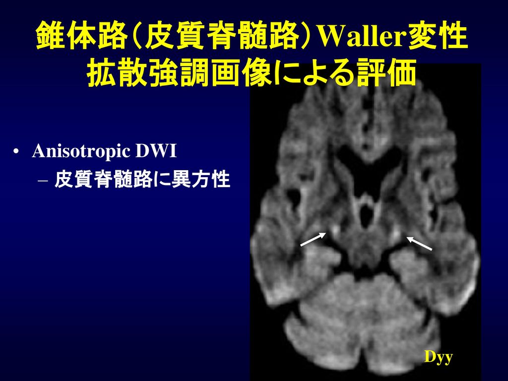錐体路（皮質脊髄路）Waller変性 拡散強調画像による評価