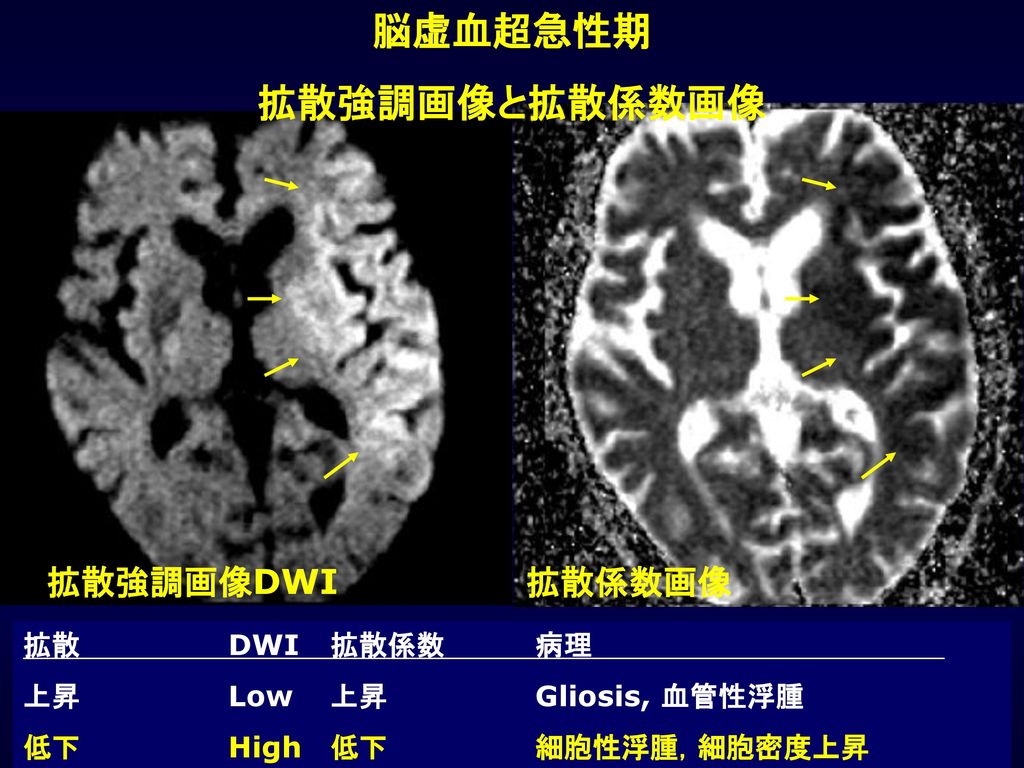 脳虚血超急性期 拡散強調画像と拡散係数画像