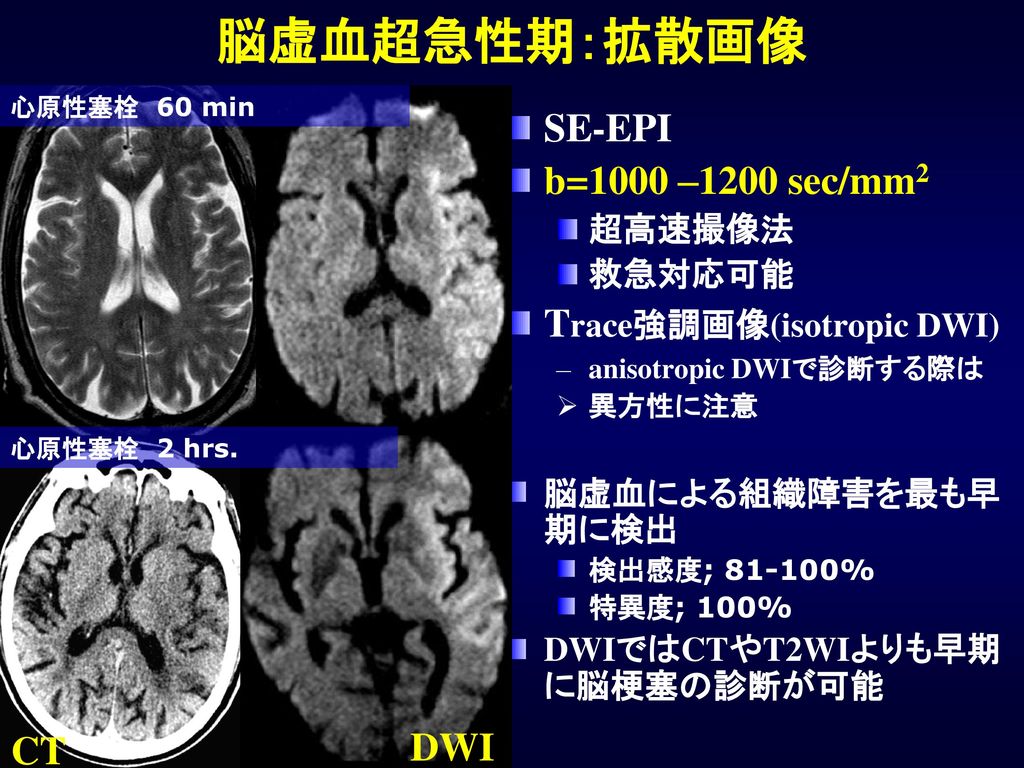 脳虚血超急性期：拡散画像 SE-EPI b=1000 –1200 sec/mm2 Trace強調画像(isotropic DWI) DWI
