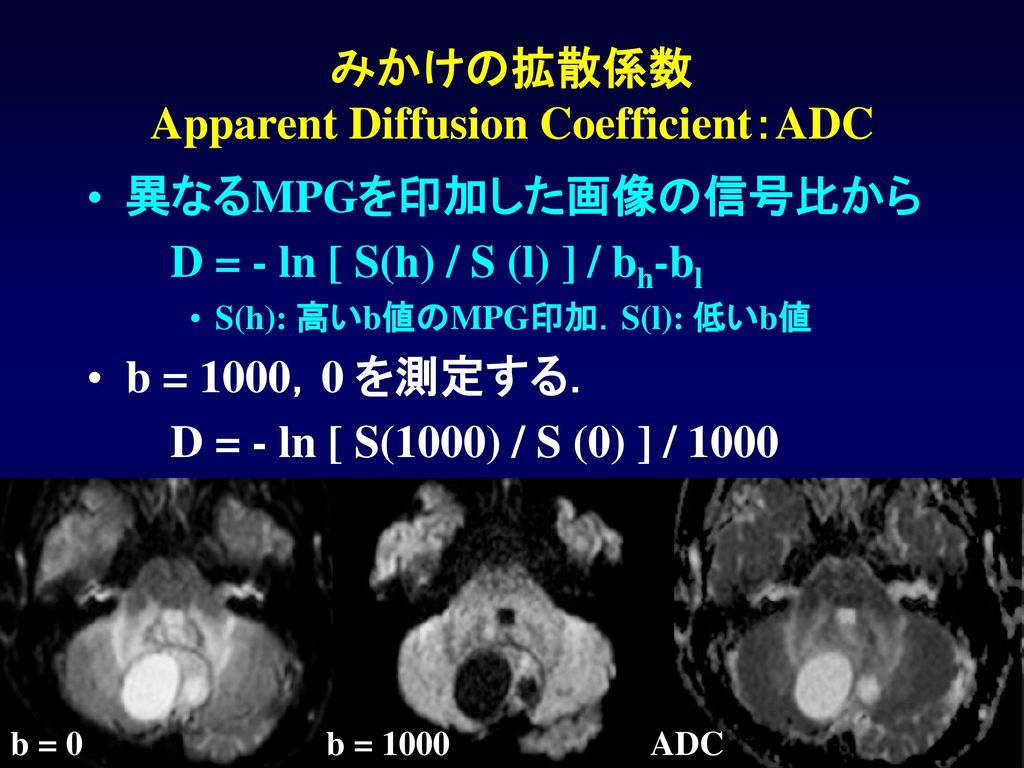 みかけの拡散係数 Apparent Diffusion Coefficient：ADC