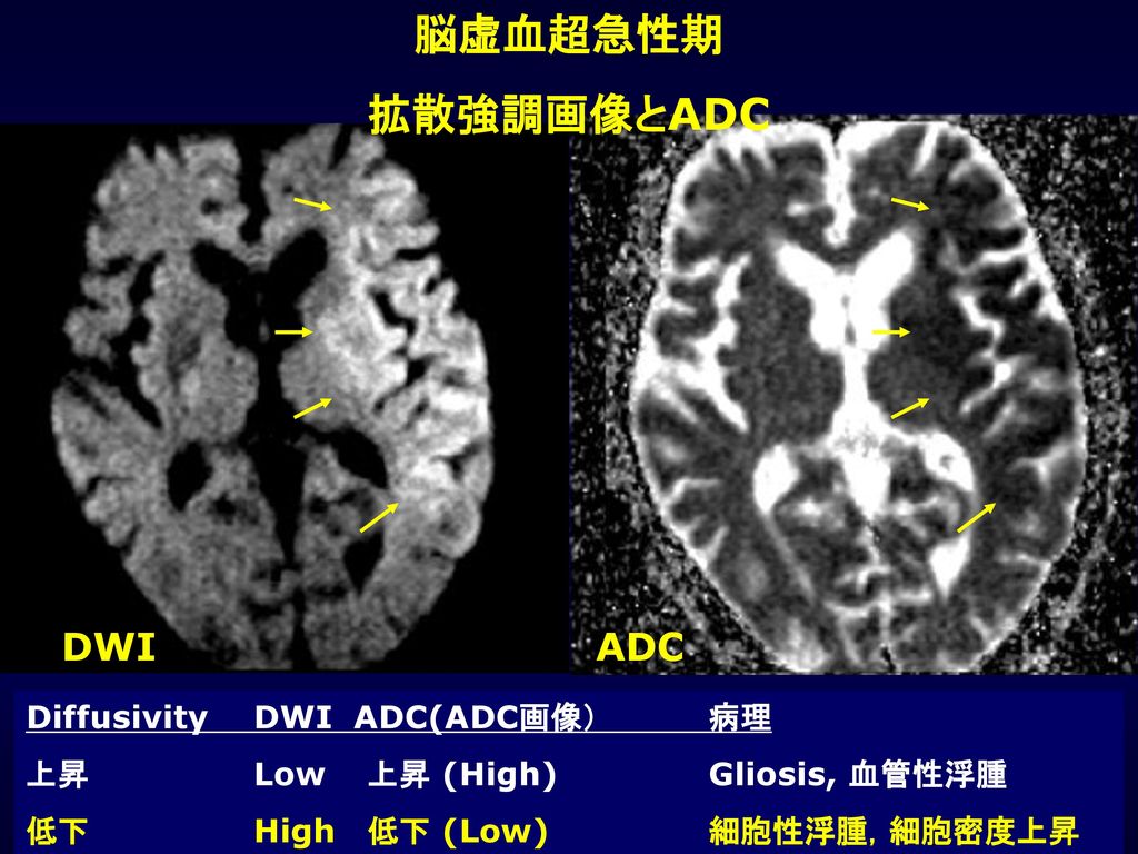 脳虚血超急性期 拡散強調画像とADC DWI ADC Diffusivity DWI ADC(ADC画像） 病理