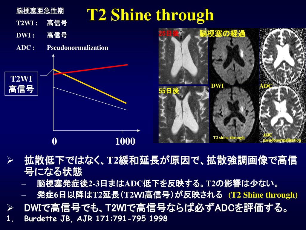 T2 Shine through 1000 拡散低下ではなく、T2緩和延長が原因で、拡散強調画像で高信号になる状態