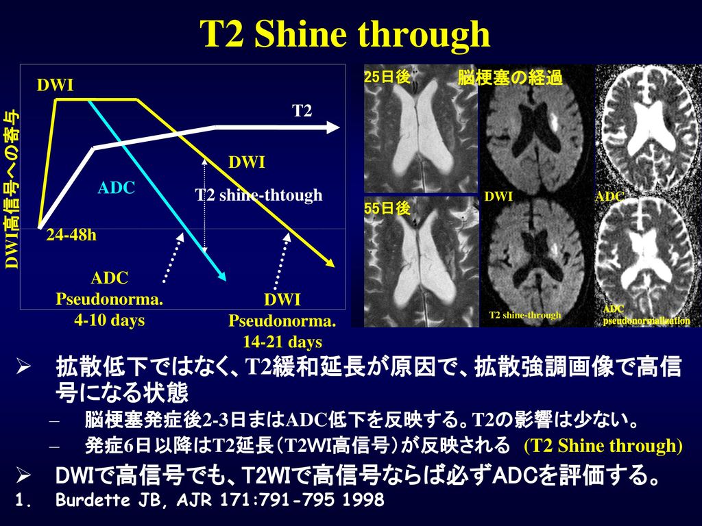 T2 Shine through 拡散低下ではなく、T2緩和延長が原因で、拡散強調画像で高信号になる状態