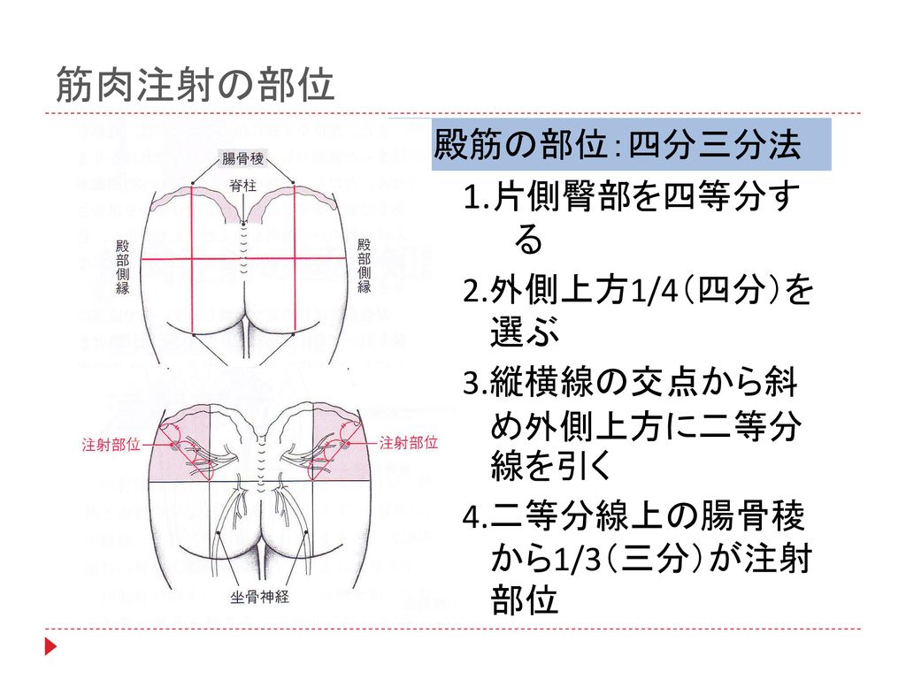 筋肉注射の部位 1.片側臀部を四等分す る 中殿筋の部位：四分三分法 2.外側上方1/4（四分）を 選ぶ