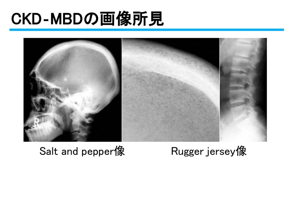 CKD‐MBDの画像所見 Salt and pepper像 Rugger jersey像 CKD‐MBDの画像所見です。