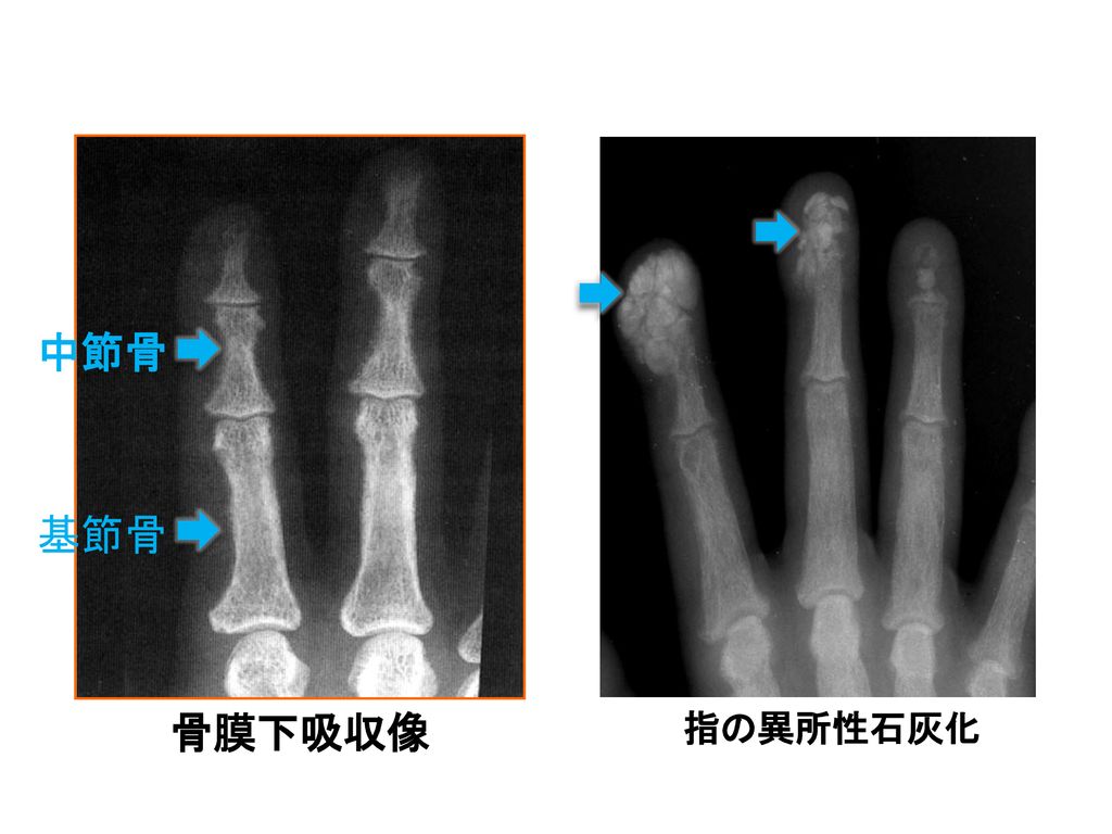 中節骨 基節骨 骨膜下吸収像 指の異所性石灰化 この写真は中手骨の代表的な骨膜下吸収像と呼ばれる所見です。 これは第二、第三中手骨の中節骨、