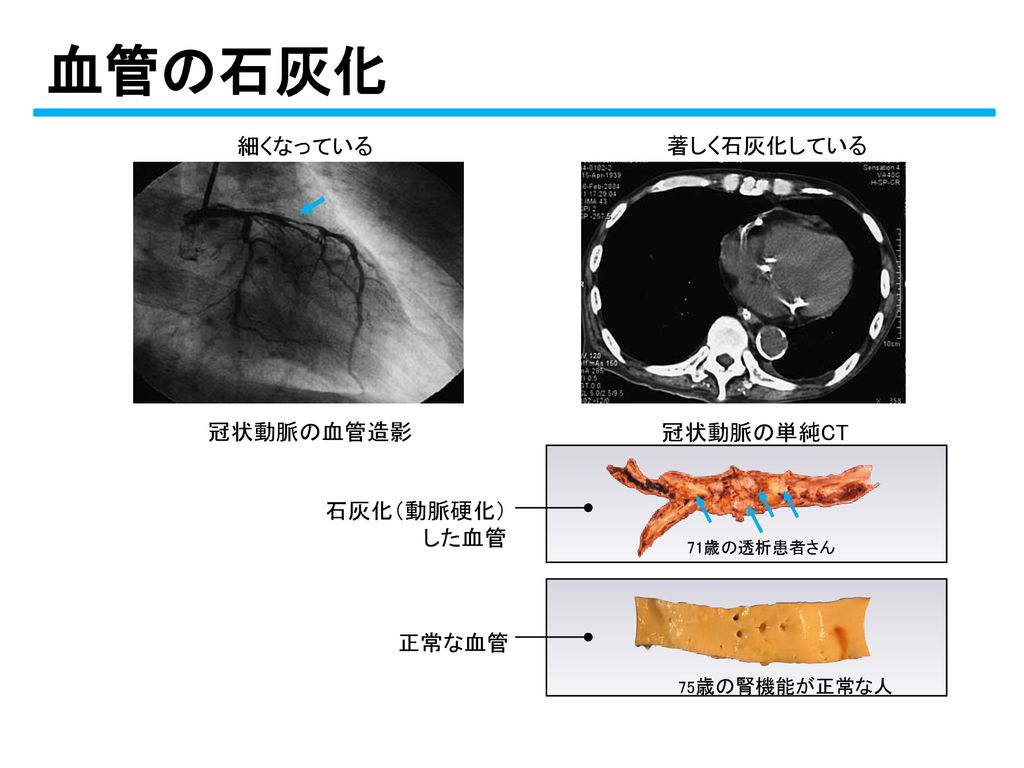 血管の石灰化 細くなっている 著しく石灰化している 冠状動脈の血管造影 冠状動脈の単純CT 石灰化（動脈硬化） した血管 正常な血管