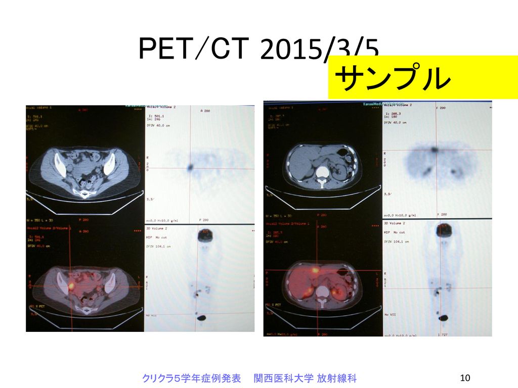 PET/CT 2015/3/5 サンプル