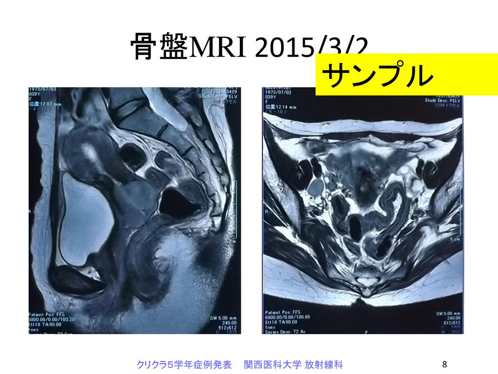 骨盤MRI 2015/3/2 サンプル