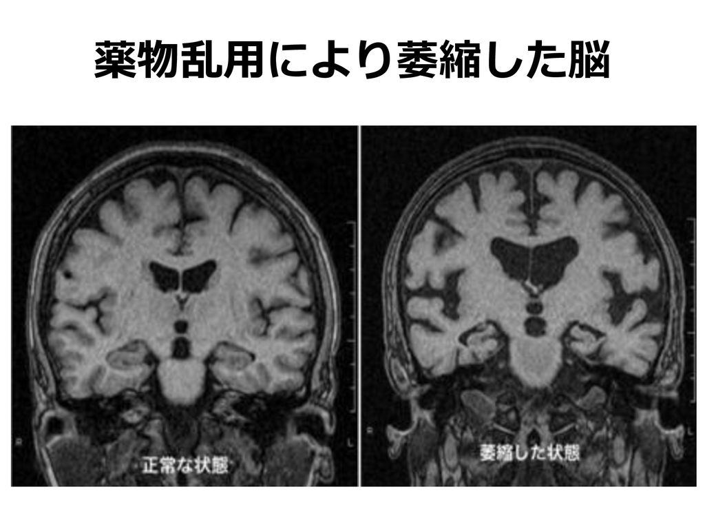 薬物乱用により萎縮した脳 こちらは，薬物の影響を受けた脳の，実際の写真です。 左側が健康な人の脳，右側が薬物を乱用した人の脳の断面写真です。