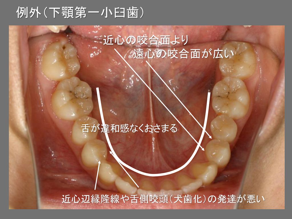 例外（下顎第一小臼歯） 近心の咬合面より 遠心の咬合面が広い 舌が違和感なくおさまる 近心辺縁隆線や舌側咬頭（犬歯化）の発達が悪い