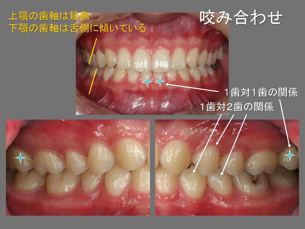 咬み合わせ 上顎の歯軸は頬側 下顎の歯軸は舌側に傾いている １歯対１歯の関係 １歯対２歯の関係