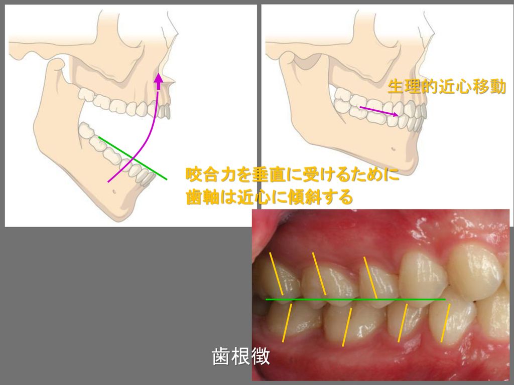 生理的近心移動 咬合力を垂直に受けるために 歯軸は近心に傾斜する 歯根徴