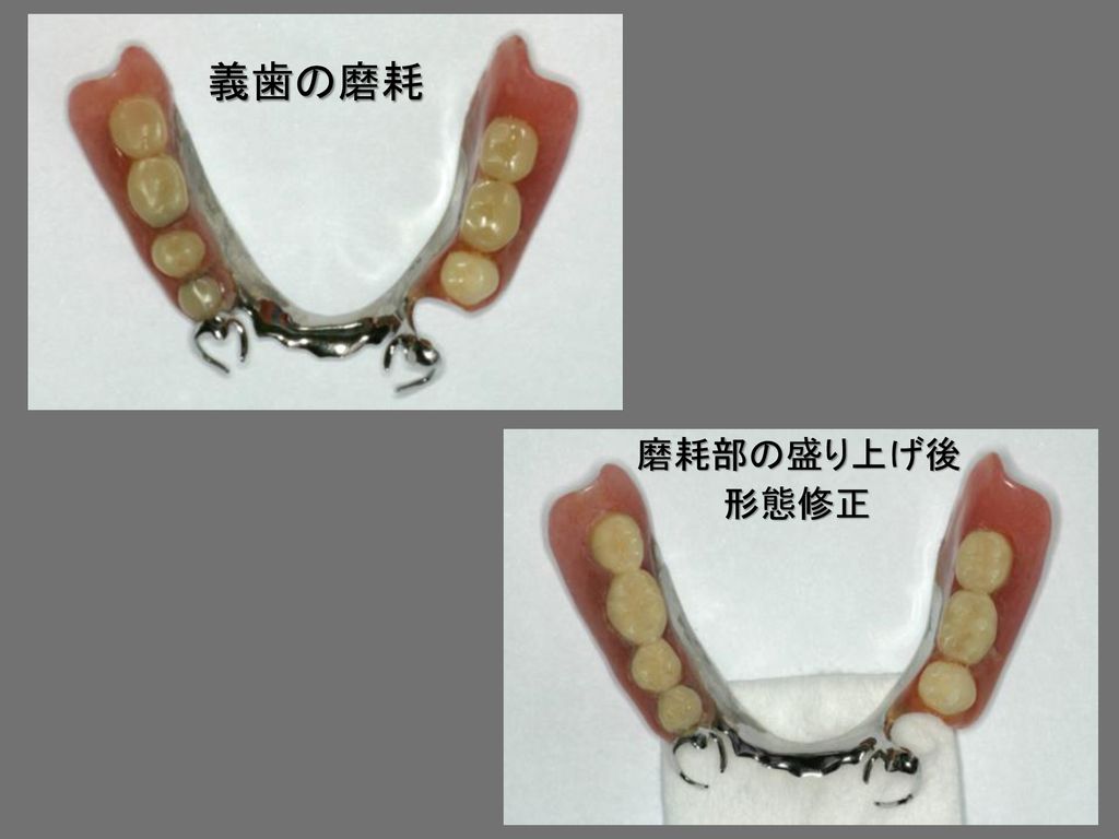 義歯の磨耗 磨耗部の盛り上げ後 形態修正