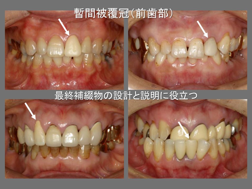 暫間被覆冠（前歯部） 最終補綴物の設計と説明に役立つ