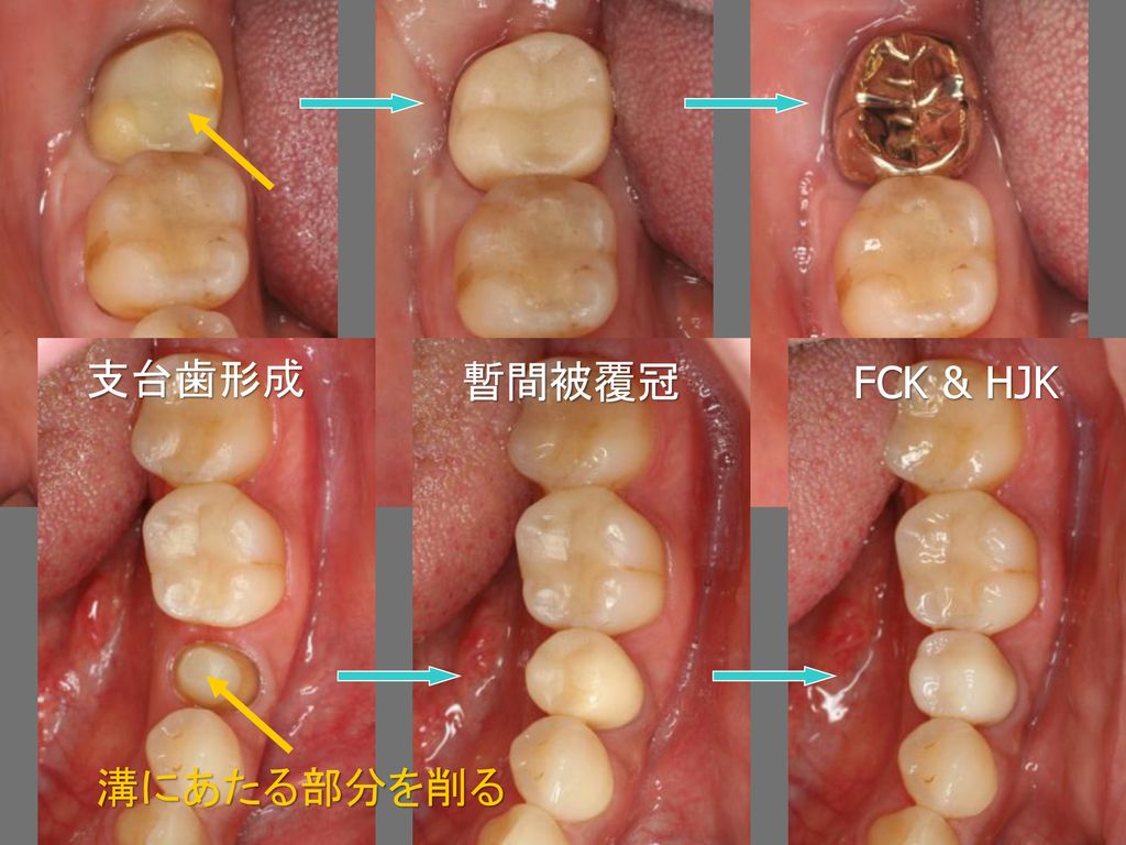 支台歯形成 暫間被覆冠 FCK & HJK 溝にあたる部分を削る