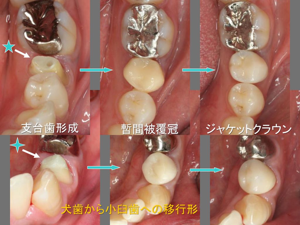 支台歯形成 暫間被覆冠 ジャケットクラウン 犬歯から小臼歯への移行形