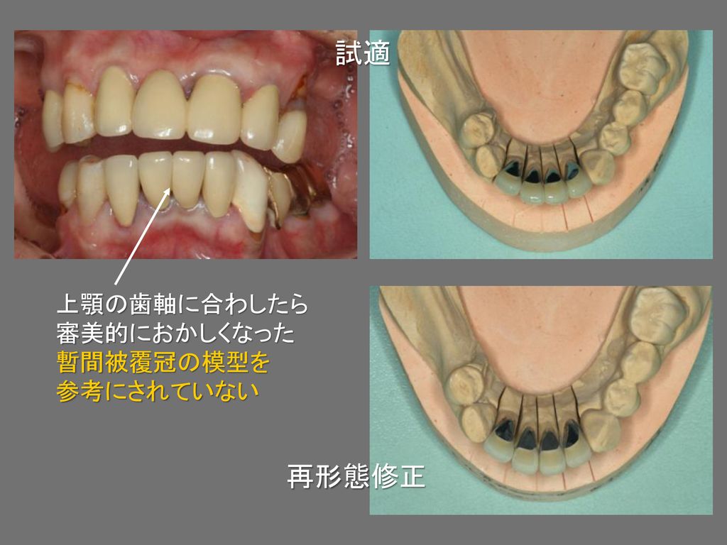 試適 上顎の歯軸に合わしたら 審美的におかしくなった 暫間被覆冠の模型を 参考にされていない 再形態修正