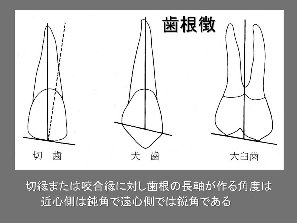 歯根徴 切縁または咬合縁に対し歯根の長軸が作る角度は 近心側は鈍角で遠心側では鋭角である