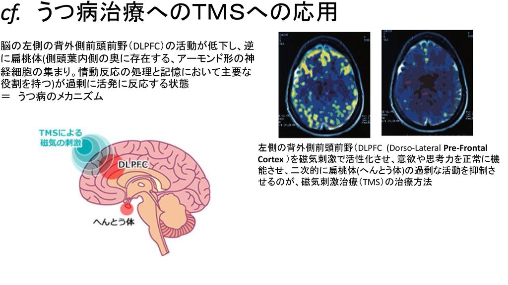 脳梗塞について ｂｍｅでの救命応用 ２０１６年３月１９日 土 岡田一秀 Ppt Download