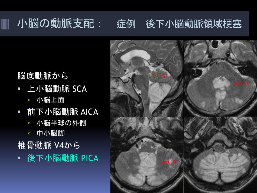 小脳の動脈支配： 症例 後下小脳動脈領域梗塞