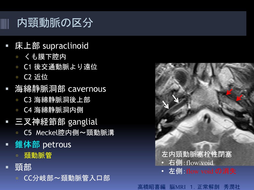 硬膜動静脈奇形 Developmental Venous Anomaly Ppt Download