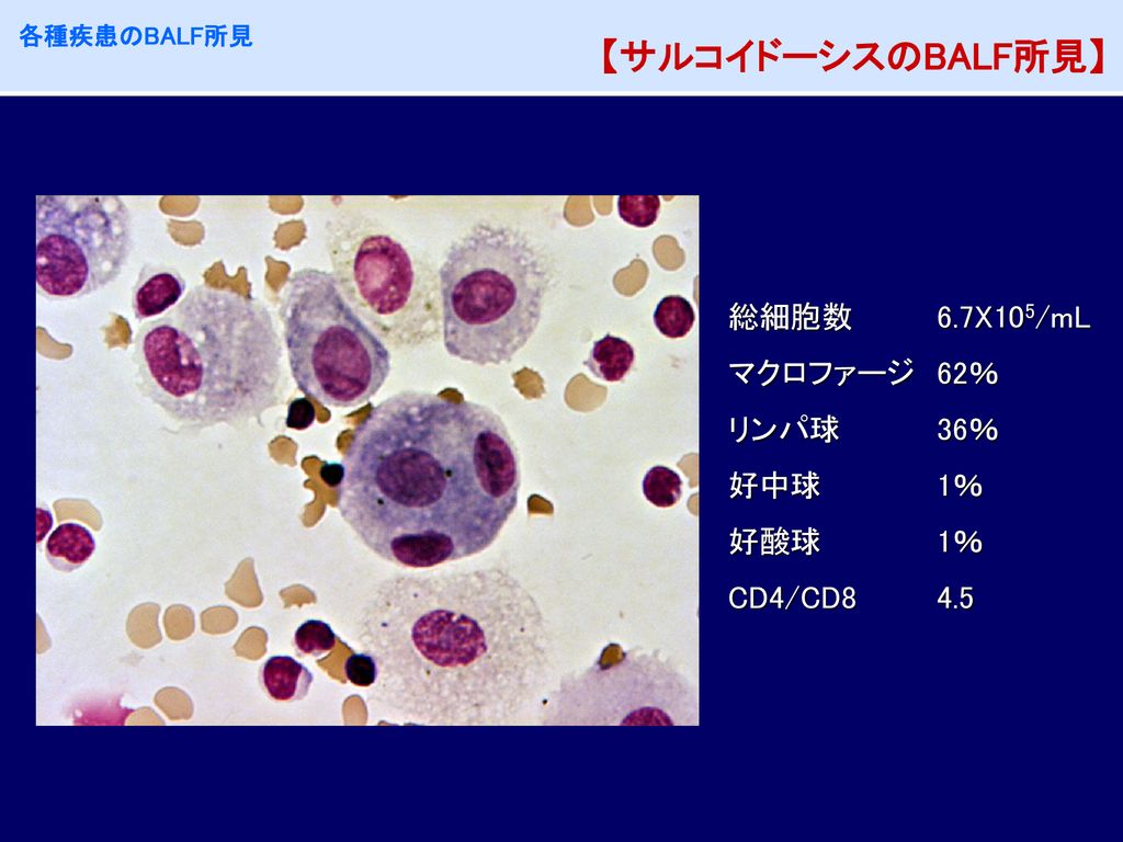 【サルコイドーシスのBALF所見】 総細胞数 6.7X105/mL マクロファージ 62％ リンパ球 36％ 好中球 1％ 好酸球 1％