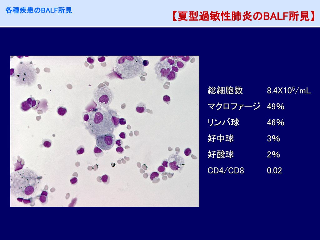 【夏型過敏性肺炎のBALF所見】 総細胞数 8.4X105/mL マクロファージ 49％ リンパ球 46％ 好中球 3％ 好酸球 2％