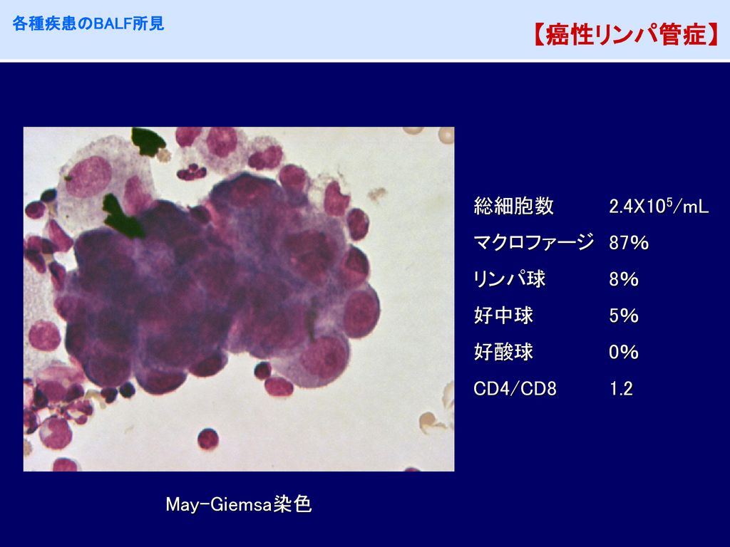 【癌性リンパ管症】 総細胞数 2.4X105/mL マクロファージ 87％ リンパ球 8％ 好中球 5％ 好酸球 0％