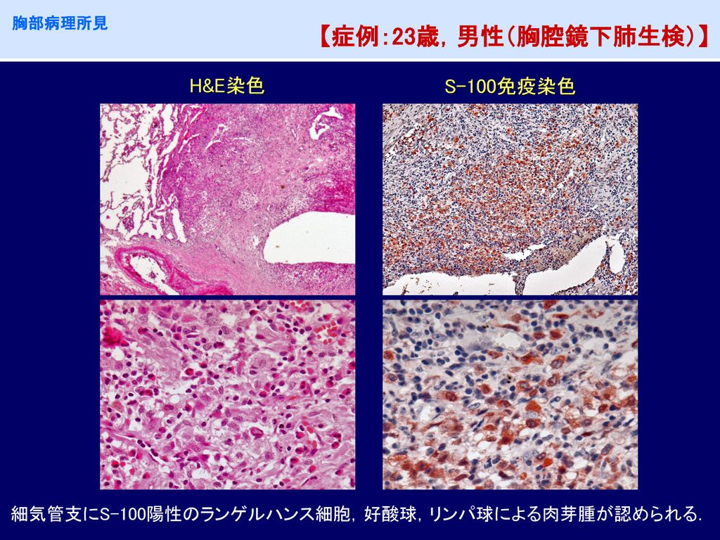 肺ランゲルハンス細胞組織球症 Pulmonary Langerhans Cell Histiocytosis Plch Ppt Download