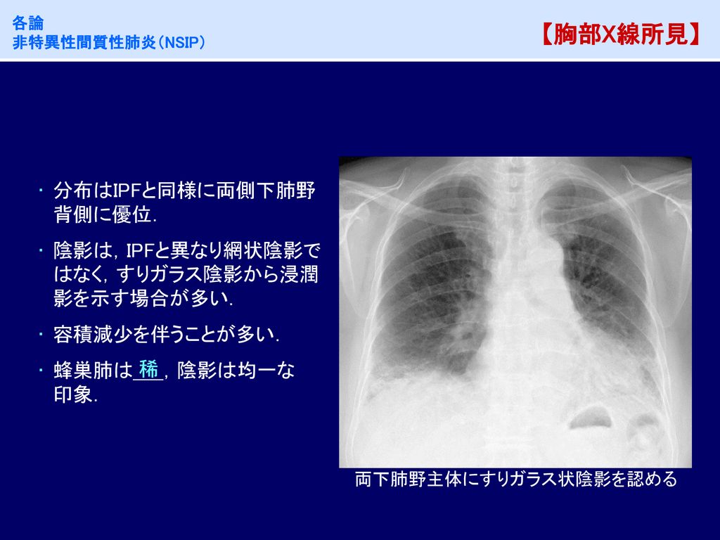 【胸部X線所見】 分布はIPFと同様に両側下肺野背側に優位．