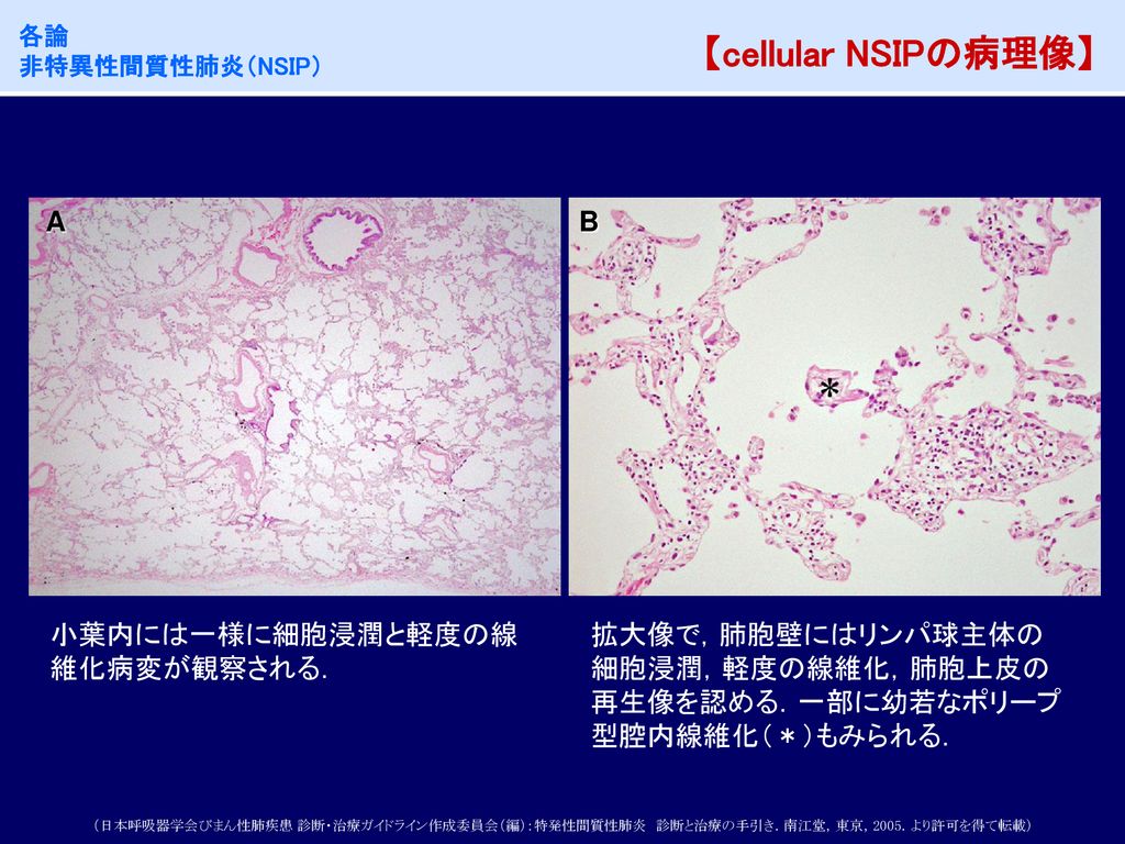 【cellular NSIPの病理像】 A B 小葉内には一様に細胞浸潤と軽度の線維化病変が観察される．