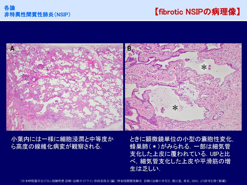【fibrotic NSIPの病理像】 A B 小葉内には一様に細胞浸潤と中等度から高度の線維化病変が観察される．