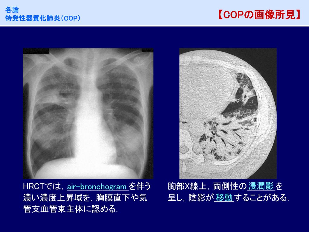 【COPの画像所見】 HRCTでは， を伴う濃い濃度上昇域を，胸膜直下や気管支血管束主体に認める． air-bronchogram