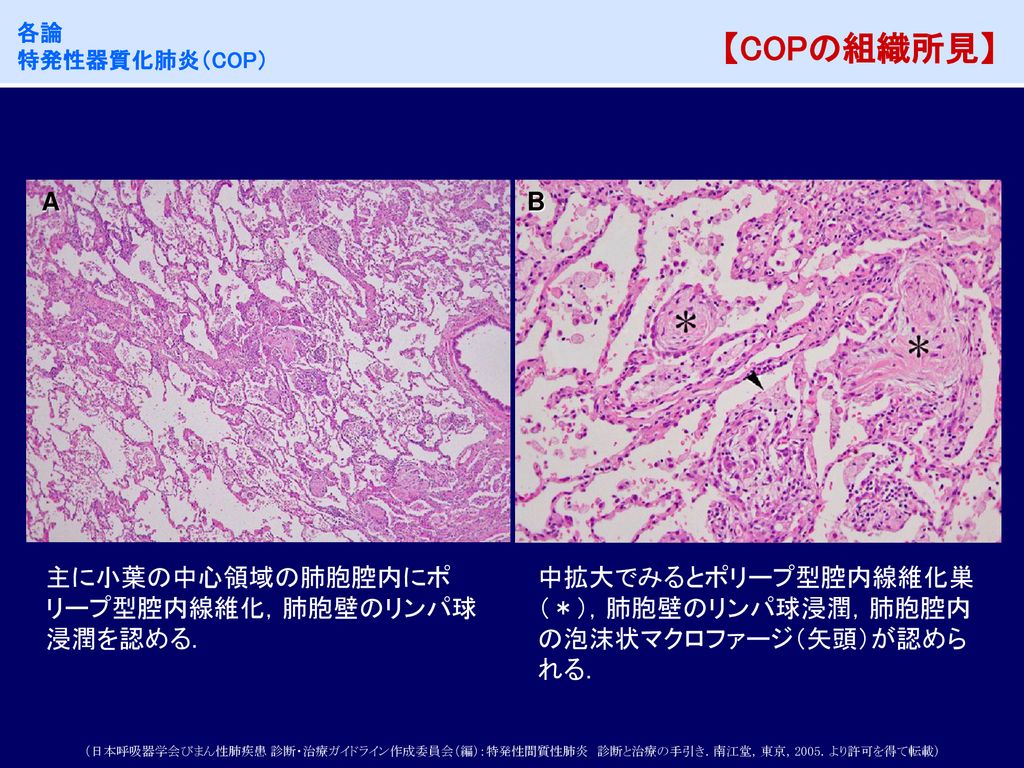 【COPの組織所見】 A B 主に小葉の中心領域の肺胞腔内にポリープ型腔内線維化，肺胞壁のリンパ球浸潤を認める．