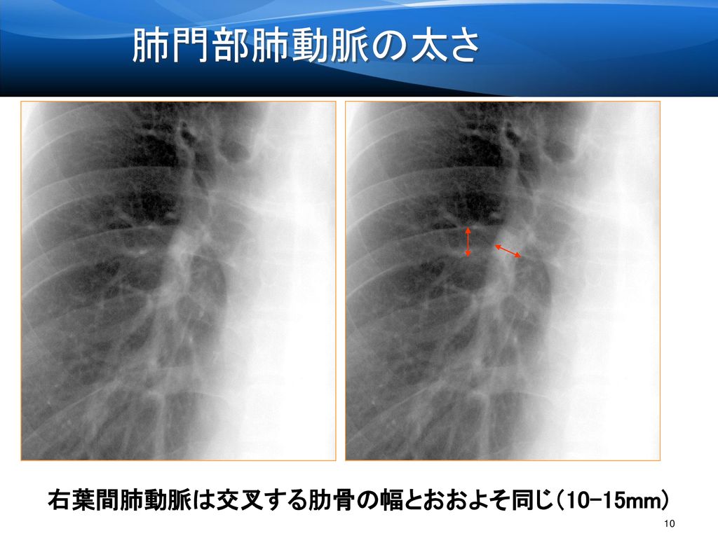 肺門部肺動脈の太さ 右葉間肺動脈は交叉する肋骨の幅とおおよそ同じ（10-15mm)