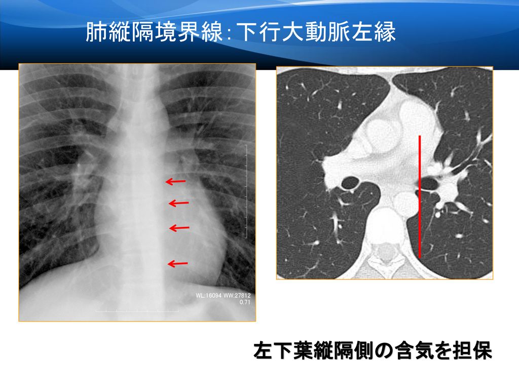 肺縦隔境界線：下行大動脈左縁 左下葉縦隔側の含気を担保 12 下行大動脈左縁と奇静脈食道線