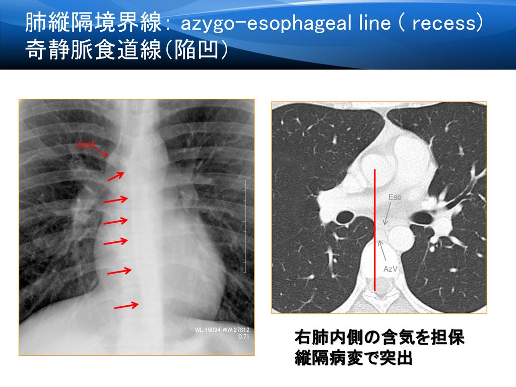 肺縦隔境界線： azygo-esophageal line ( recess) 奇静脈食道線（陥凹）