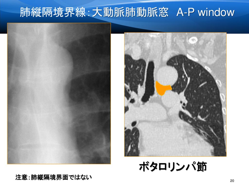肺縦隔境界線：大動脈肺動脈窓 A-P window
