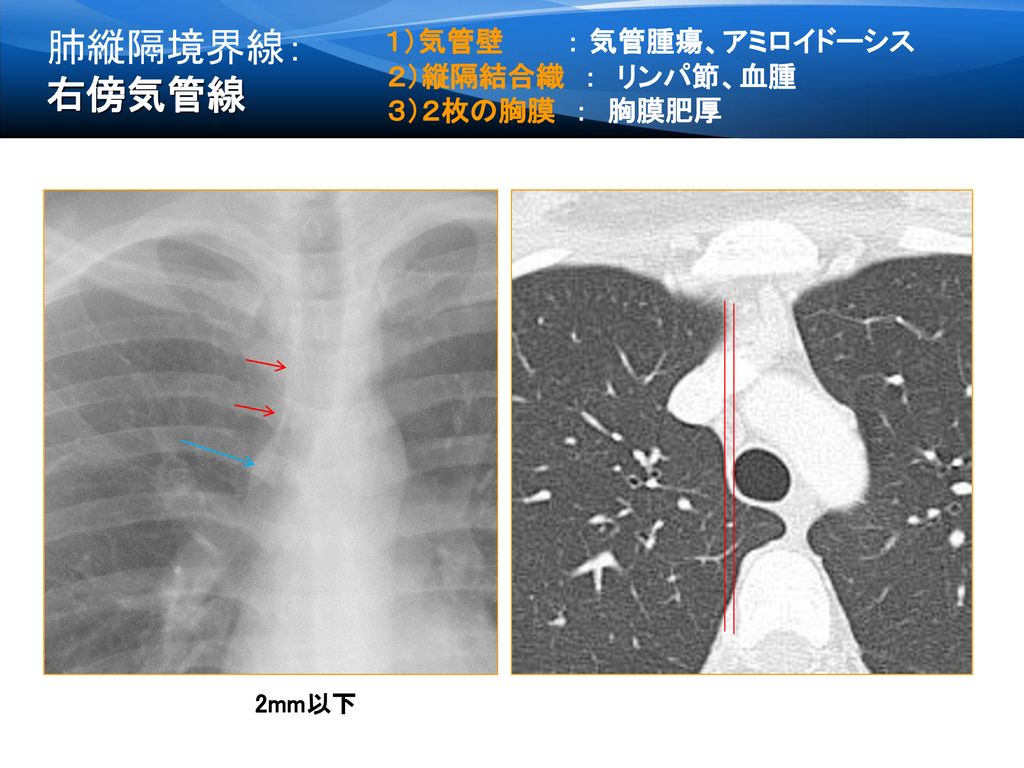 肺縦隔境界線：右傍気管線 １）気管壁 ： 気管腫瘍、アミロイドーシス ２）縦隔結合織 ： リンパ節、血腫 ３）２枚の胸膜 ： 胸膜肥厚