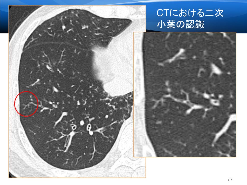 CTにおける二次小葉の認識 5. 小葉内分岐構造：Reidの小葉 細気管支炎