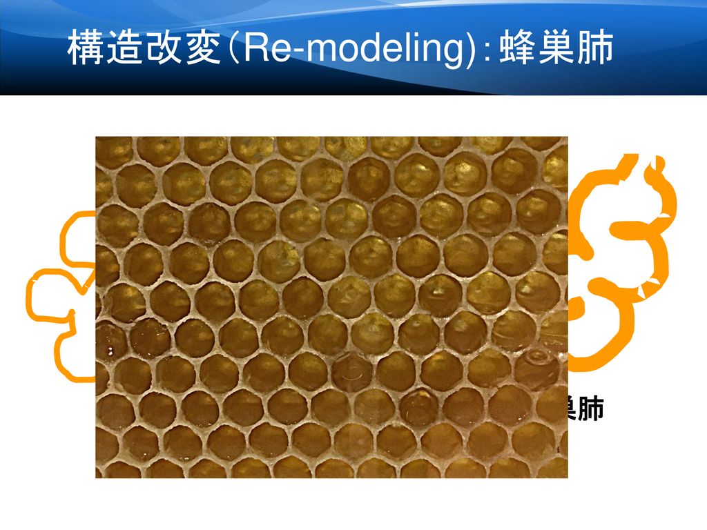 構造改変（Re-modeling)：蜂巣肺