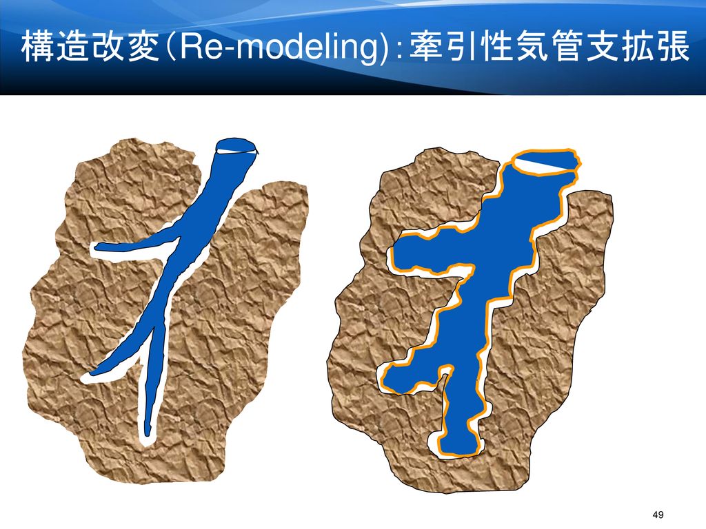 構造改変（Re-modeling)：牽引性気管支拡張