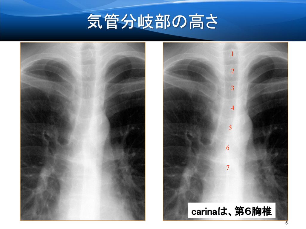 気管分岐部の高さ carinaは、第６胸椎