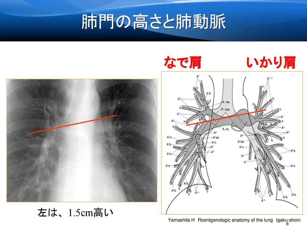 肺門の高さと肺動脈 なで肩 いかり肩 左は、1.5cm高い